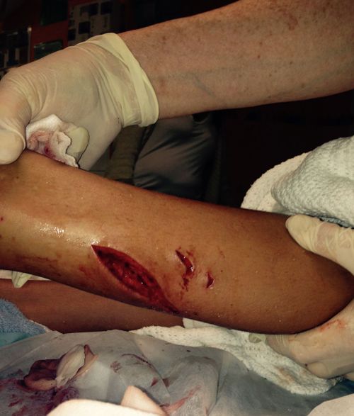 The 13-year-old's left leg sliced open in shark attack. (Supplied)