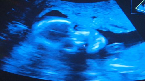 A private health insurer may not cover ultrasounds.