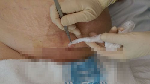 Photo of the mum's infected incision being dressed. (Supplied)