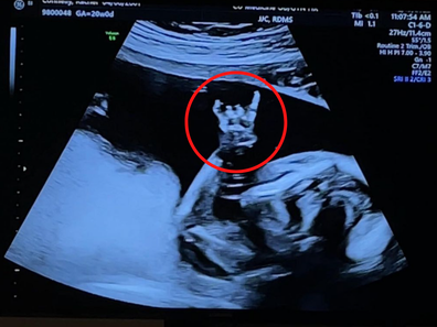 Digital creator, Rachel Connelly's ultrasound scan with baby appearing to make 'I love you' ASL gesture.