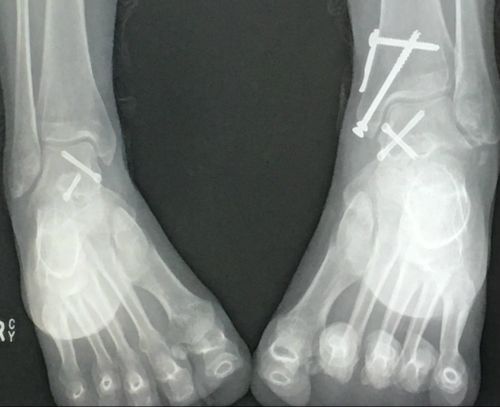 An x-ray of Ms McDonald's feet and ankles. Picture: Jade McDonald