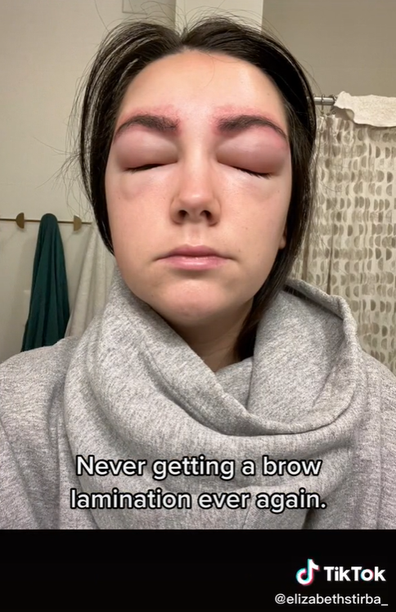 Woman's horrible allergic reaction to brow lamination.
