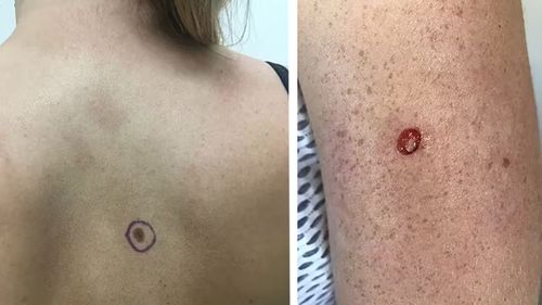 A large mole on Danielle Rancie's back turned out to be pre-cancerous. But, to her surprise, her doctor picked up a tiny spot on her arm, which was a stage-2 melanoma. 