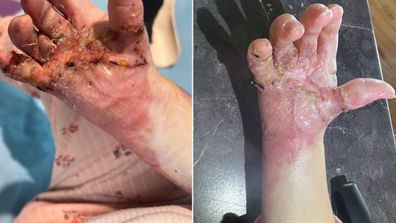 Dusty suffered severe burns to her hands and forearms