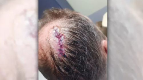 Mr Woodford required nine stitches to the back of his head following the incident. (9NEWS)
