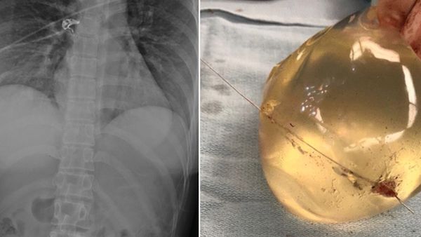Woman's breast implant deflects bullet, saving her life when she was shot  in the chest