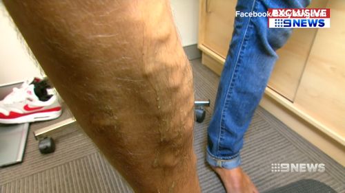 Patients can often experience swelling and discomfort. Picture: 9NEWS