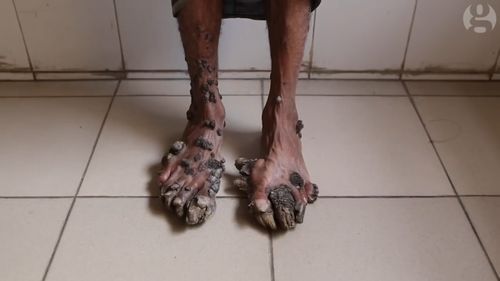 Abul Bajander's skin condition is similar to HPV and causes tree like bark to grow over his body.