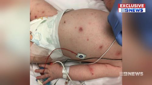 Red spots appeared on Violet's stomach and legs. Picture: 9NEWS