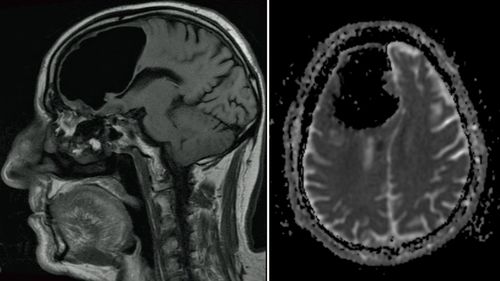 The 84-year-old man declined surgery to removed the air pocket or tumour. (BMJ Case Reports)