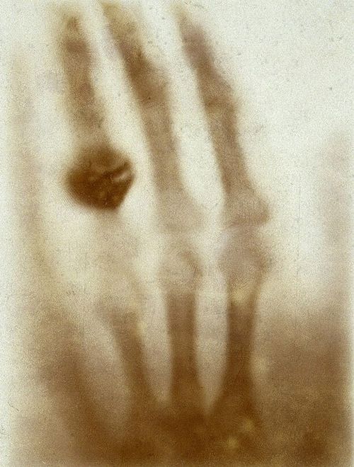 Wilhelm Rontgen'ın eşinin elinin ilk X-ışını fotoğrafı.