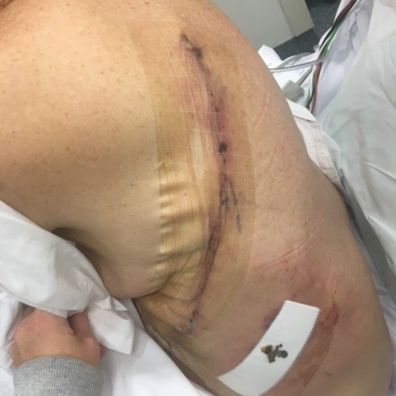 Sandie Foreman's scar after surgery to remove her lung.