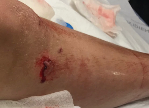 Peyton Shields required 40 stitches after a shark attack at Crescent Beach, Bakers County Florida last week.