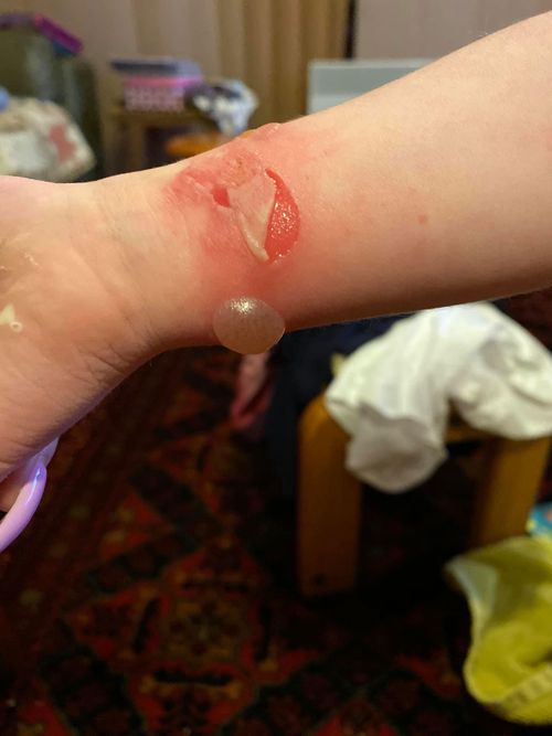 A photo showing the blisters and tearing caused by Lylah's jumper.