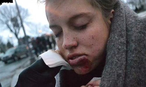 The original photo of Naomie Trudeau-Tremblay's bruised face which was edited to make light of her injuries online. (Supplied)