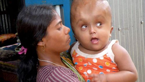 Indian girl Roona Begum with rare condition dies suddenly