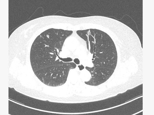 New treatment for lung cancer