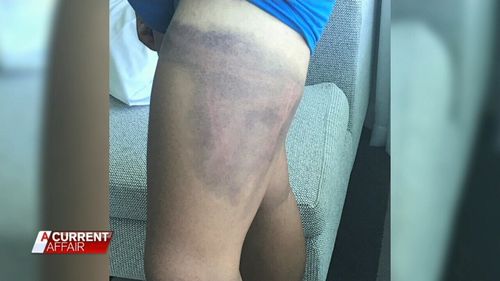 The 16-year-old sustained bruising. Picture: ACA