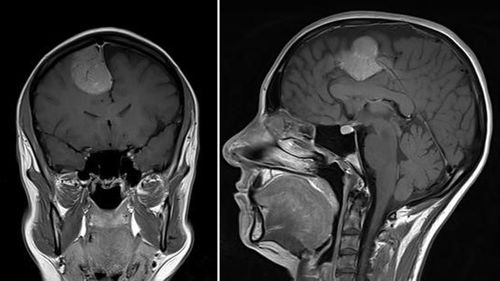 Mrs Doolan's MIR shows the malignant meningioma tumour in the frontal lobe of her brain.