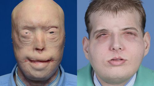 Patrick Hardison pictured before and after his surgery. (AAP)