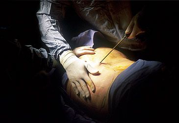 When are Arpad and Giorgio Fischer credited with inventing liposuction?