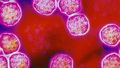 New measles case identified in Melbourne