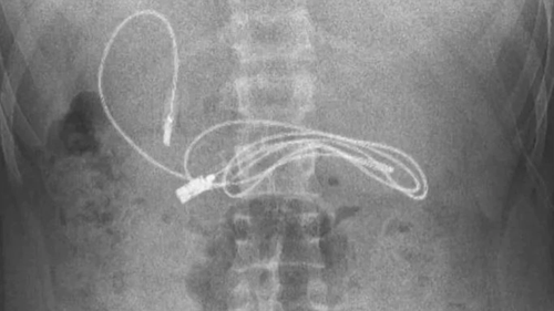 A charging cord measuring almost a metre was found inside a teen boy from Turkey.