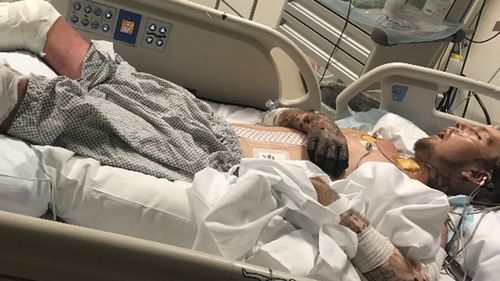 Queensland man loses both legs to meningococcal disease 