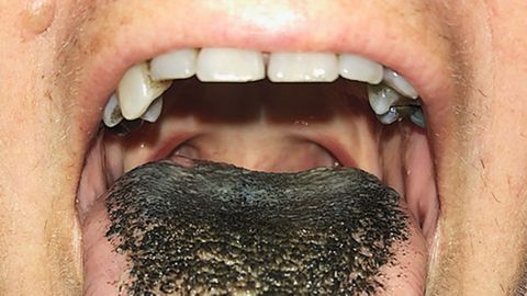 black hair on tongue