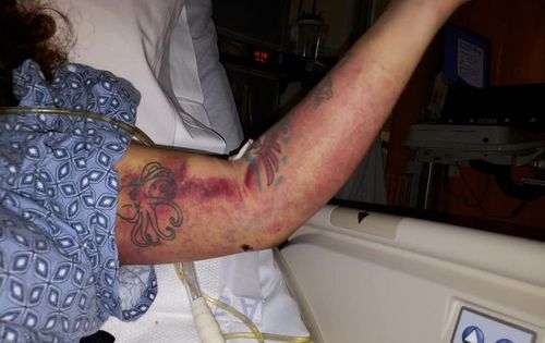 She suffered fractured ribs, broken bones and severe bruising and sunburn. Image: Facebook