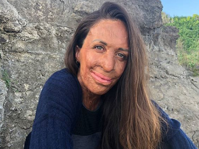 Turia Pitt sitting outdoors