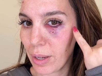 Christy Carlson Romano reveals she was shot in the face