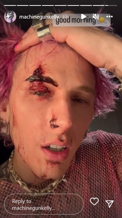 Machine Gun Kelly shares photo of bloody head injury after hitting himself with champagne glass.