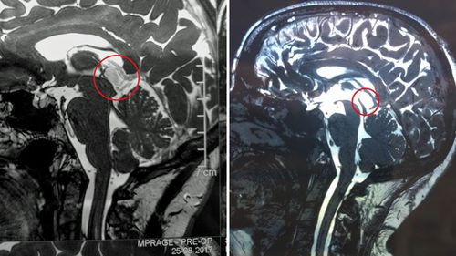 MRI scans (left) showing the cyst on Ms Warren's brain, and (right) after the cyst was removed.