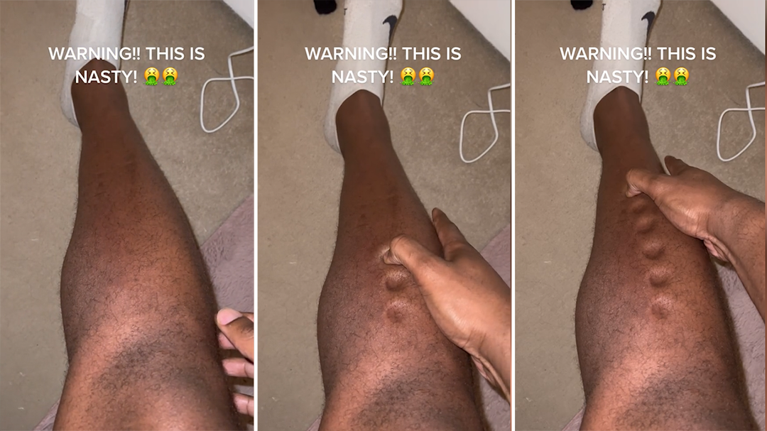 F﻿ormer British Olympian Lawrence Okoye posted this video of a &#x27;nasty&#x27; skin condition.