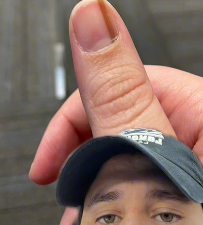 Streak on thumb cancer