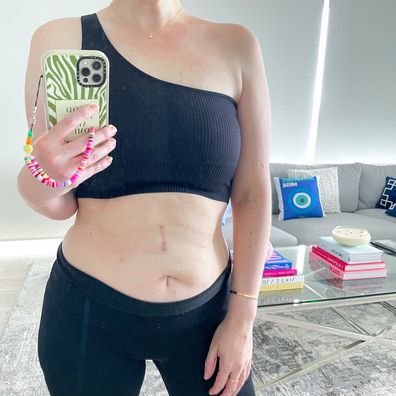 Skin cancer survivor Courtney Mangan shows the scar on her stomach.
