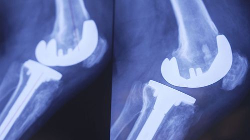 A private hospital in Sydney is offering same day knee and hip replacements to patients who are suitable for early discharge.