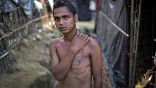 Mohammadul Hassan, 18, is photographed outside his family's tent in Jamtoli refugee camp in Bangladesh. Hassan still bears the scars on his chest and back from being shot by soldiers. (Photo: AP).