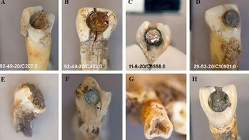 These ancient human teeth have one unusual feature in common