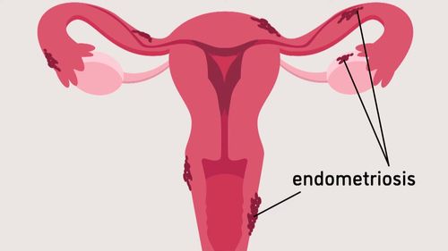 Le gouvernement fédéral s'engage à financer la recherche sur l'endométriose et la fertilité.