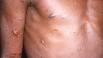 Monkeypox can be seen on a man&#x27;s body
