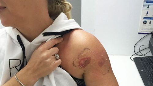 Some Thermomix customers claim their malfunctioning machines left them with burns.