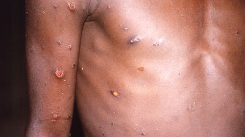 Monkeypox can be seen on a man's body