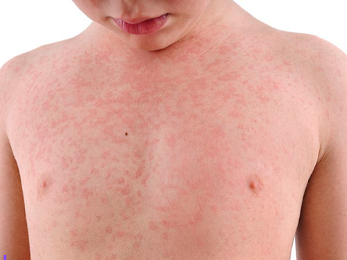 Boy with measles.
