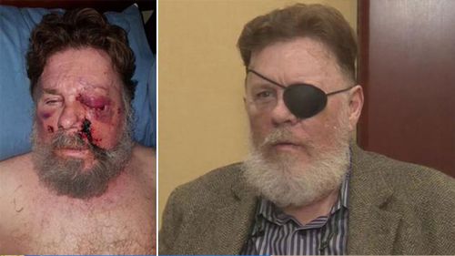 US man loses an eye after e-cigarette ‘explodes in his face’