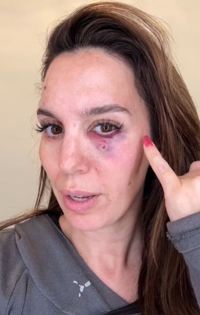 Christy Carlson Romano reveals she was shot in the face
