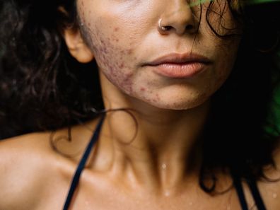 Stock photo: woman with acne poses with a leaf.