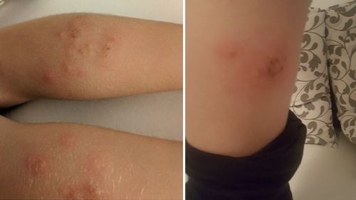 Mum and daughter ravaged by bed bugs on British Airways flight