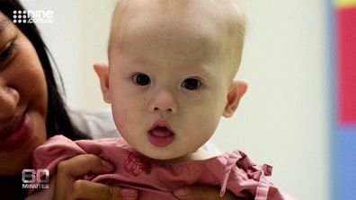 Baby Gammy, who has Down syndrome, was born to a Thai surrogate. The Australian parents of baby Gammy left him in Thailand, only returning with his healthy sister, Pipah.